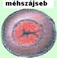 Méhszájseb lézeres műtétek