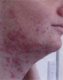 Acne (pattanásos bőr) kezelése