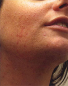 Acne (pattanásos bőr) kezelése
