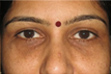 Seborrheás keratosis