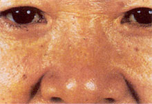 Seborrheás keratosis