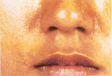 Seborrheás keratosis