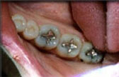 Inlay