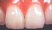 Inlay