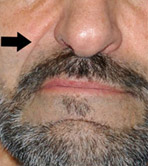 Ráncfeltöltés Restylane