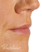 Ráncfeltöltés Restylane