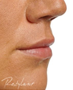 Ráncfeltöltés Restylane