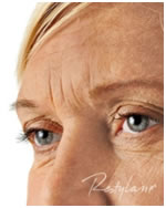 Ráncfeltöltés Restylane