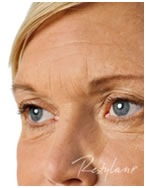 Ráncfeltöltés Restylane