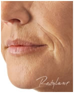 Ráncfeltöltés Restylane