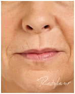 Ráncfeltöltés Restylane