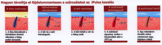 Végleges szőrtelenítés