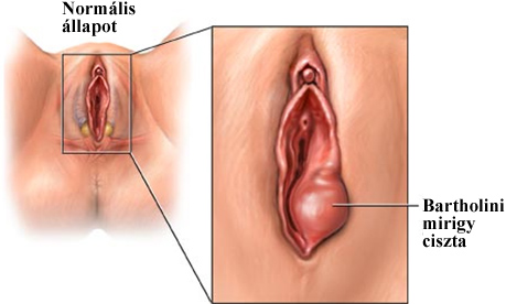 Bartholini-mirigy ciszta