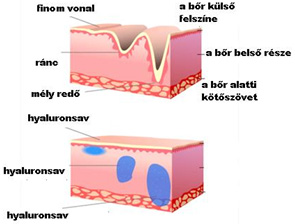 Ráncfeltöltés Ellanse-vel