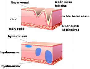 Ráncfeltöltés ESSEDERM-mel