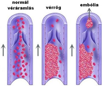 Végbélvéna trombózis