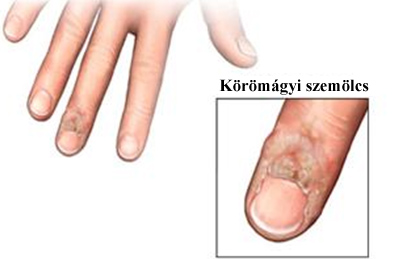 Körömágynál lévő vírusszemölcsök 