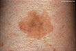 Seborrheás keratosis