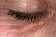 Xanthelasma