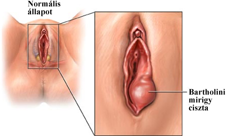 condyloma ciszta endometrium rák pembrolizumab