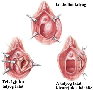 Bartholini-mirigy ciszta