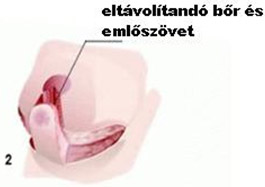 Emlőkisebbitő műtét