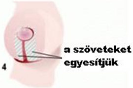 Emlőkisebbitő műtét