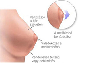 Emlőműtét