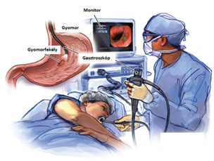 gasztroszkópia és rossz lehelet)