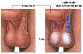 Varicocele kezelése műtét nélküli férfiaknál: használt gyógyszerek, kezelések és egyéb módszerek