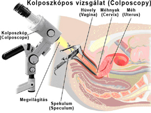 Hüvelyplasztika