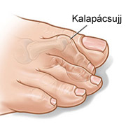 Kalapácsujj