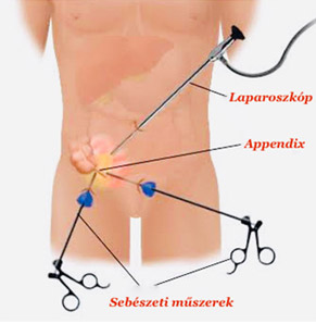 Laparoszkópos vakbélműtét