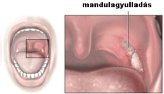 A krónikus mandulagyulladás tünetei és kezelése - A mandula a dohányzás miatt fáj