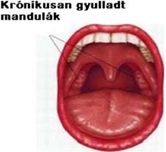 Krónikus mandulagyulladás