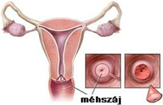 Méhszájseb hideg késes konizációs műtét