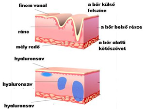 Ránctalanítás, ráncfeltöltés, arcránctalanítás