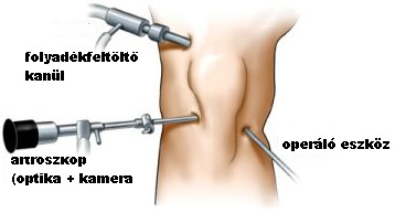Artroszkópos kivizsgálás és műtétek