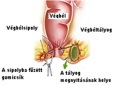 ízületi fistula kezelés