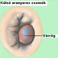 Végbélvéna trombózis
