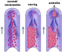 műtét visszér trombózis)