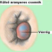 Végbélvéna trombózis