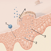 A HPV (humán papillomavírus) fertőzés tünetei, kezelése