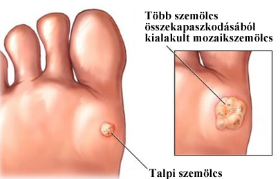 szemölcs égetése után)