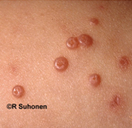 Molluscum contagiosum