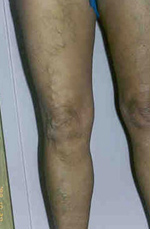 gyógynövények visszér és fáradtság ellen a varikózis oka a lábon