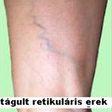 visszér alsó lábszáron zúzódásokkal viszketés a lábakon visszér kezelés