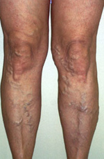 Töltenek-e műtét után a visszerek gyógyszerek a varikózis kezelésére a lábakon