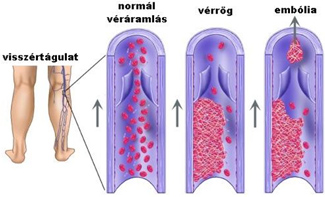 sürgősségi lábműtét visszér)