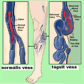 Miért visszér a jobb lábon, Visszeres fájdalom vagy trombózis?
